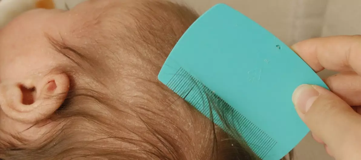 قشرة الشعر عند الرضع | سر قبعة المهد